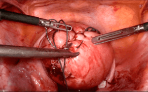 Miyom Tedavi Yöntemleri