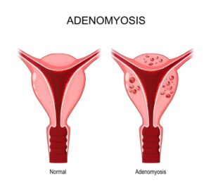 Adenomyozis Belirtileri