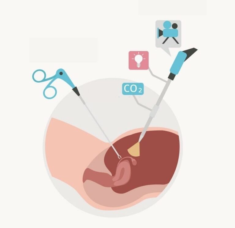 Laparoskopik Cerrahi