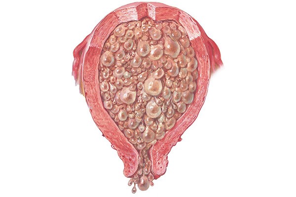 Mol Gebelik Tedavisi