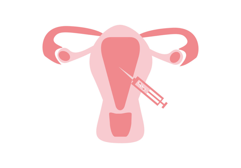 dondurulmus-embriyo-transferi-nedir-avantajlari-nelerdir